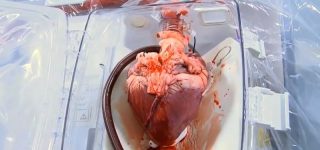 Co trzeba wiedzieć o transplantacji serca