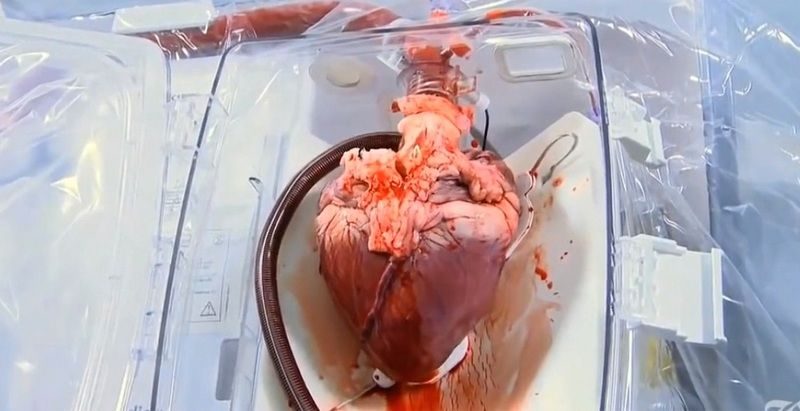 What you need to know about heart transplantation