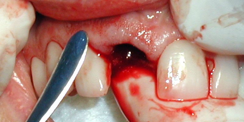 Blood collected from the gums in the periodontal area as a screening tool for diabetes