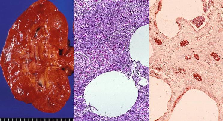 Emphatic nephritis and renal papillary necrosis