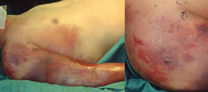 Progressive gangrene of the limbs caused by Vibrio vulnificus infection